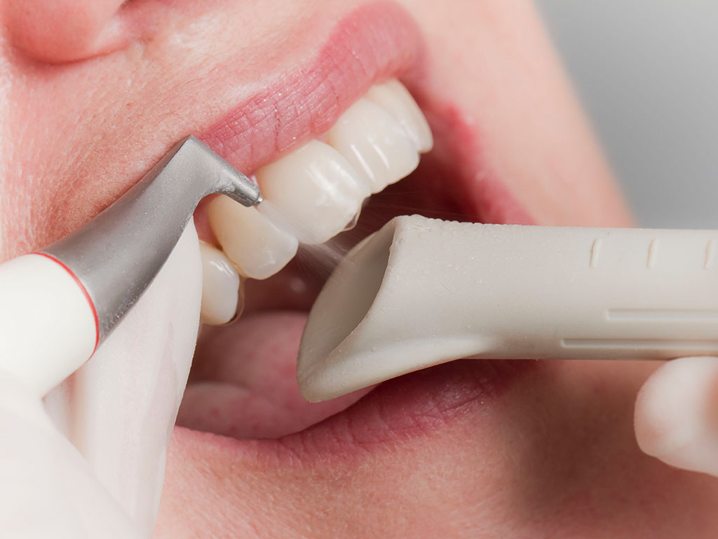 Гигиена полости рта - профессионально, в стоматологическом кабинете