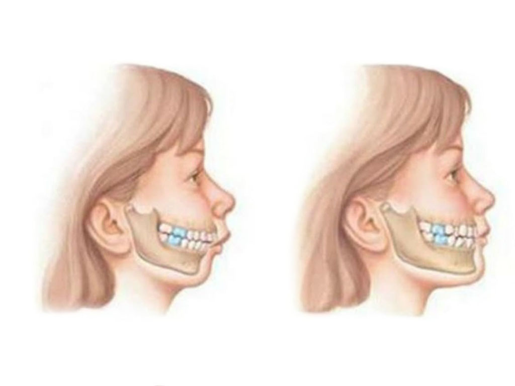 Как исправить неправильный прикус челюсти