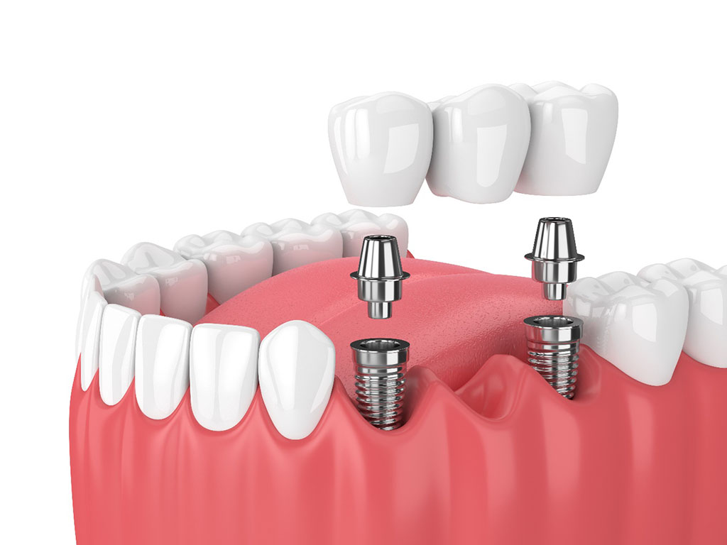 Как происходит имплантация после удаления зуба