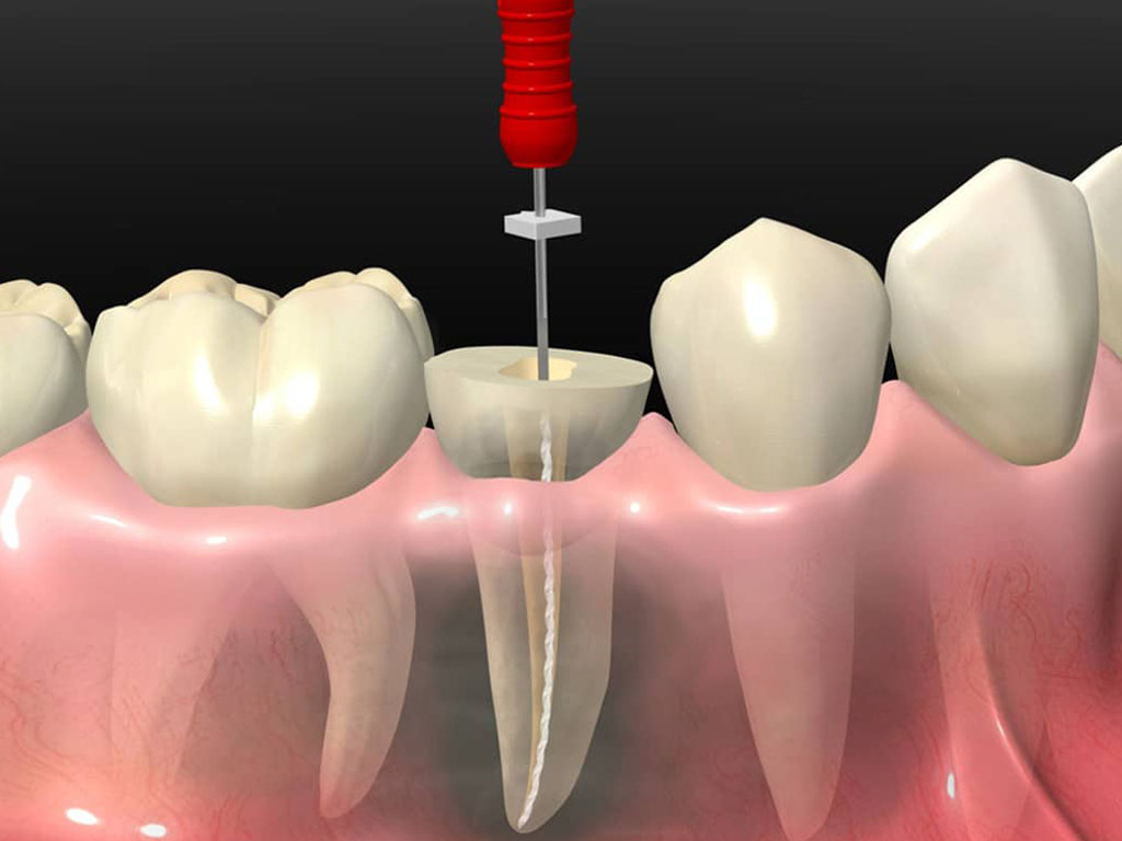 Лечение каналов зуба