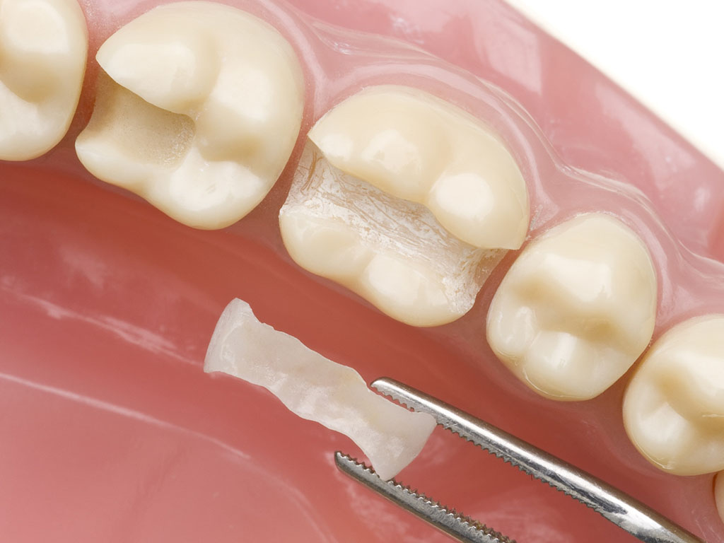 Восстановление боковых зубов